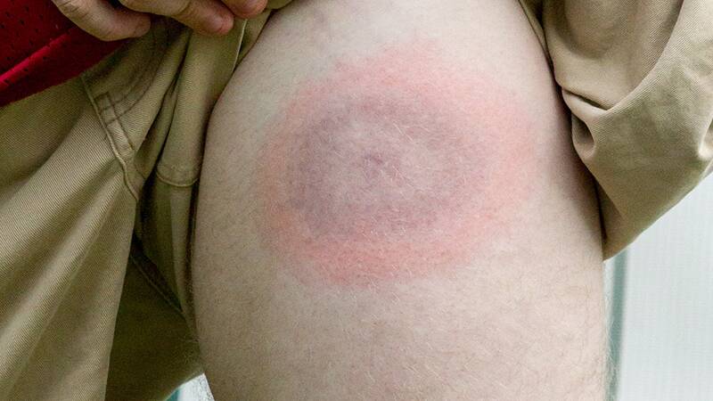 This bulls-eye rash, from a tick bit in the US state of Virginia, is a sign of potential tick disease and which requires immediate antibiotics as prescribed by a doctor, advocates a retired veterinarian who did his research on cattle.